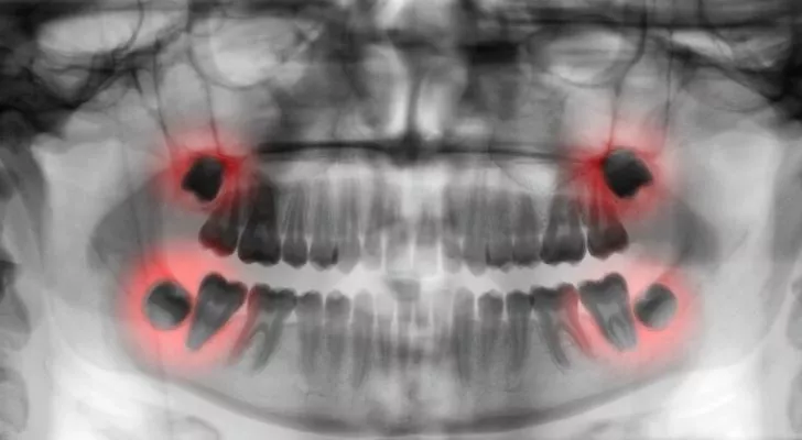 Рентгенова снимка на зъби с мъдреци, показани в червено
