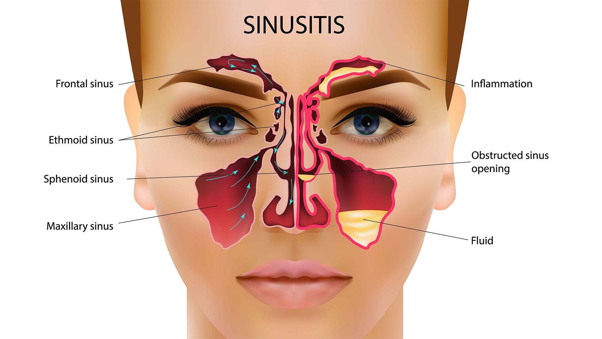 диаграмата показва човешко лице с разрез, за ​​да покаже здрави синуси от лявата страна и червени, пълни със слуз синуси отдясно