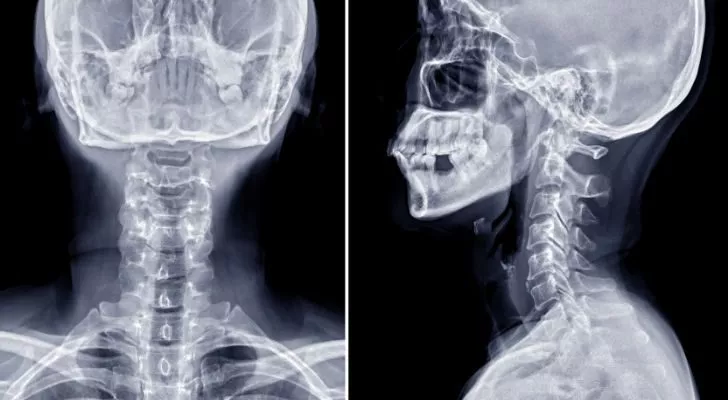 An X-ray of a person's neck and skull shown from the front and the side