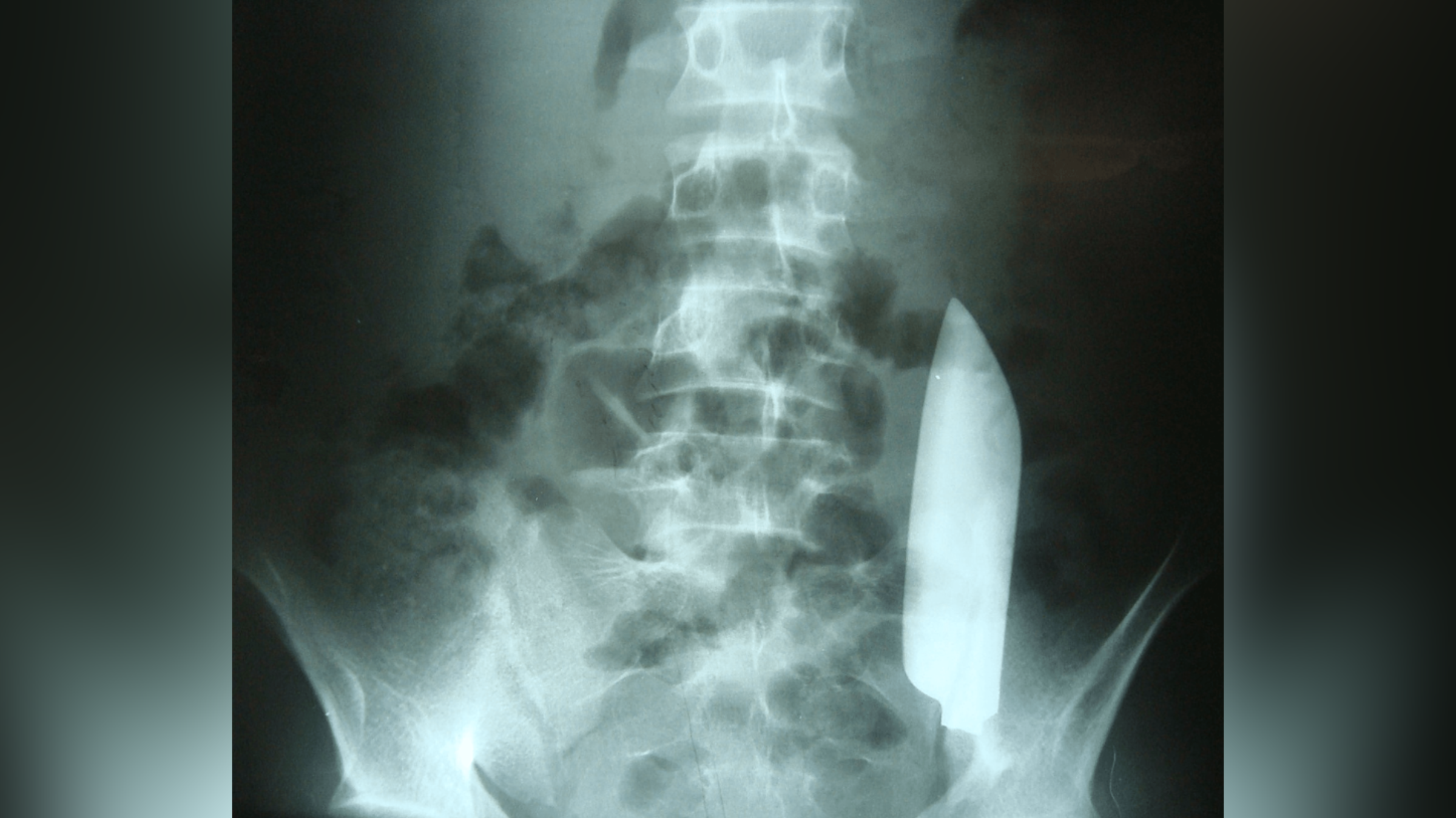 Рентгенова снимка на острието на ножа, забито в корема на мъжа