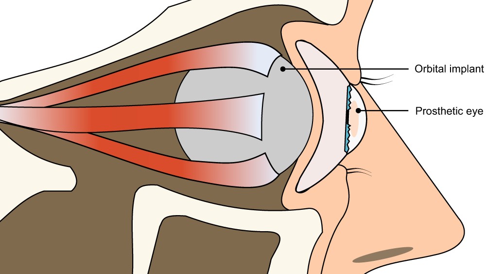 Диаграма на окото, изобразяваща позицията на очния имплант по отношение на протезно око и клепачите